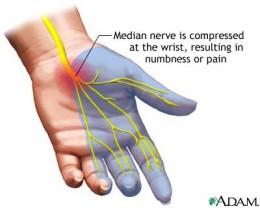 Nerve involvement in Sjogren's 